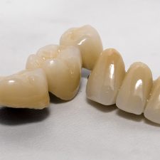 All You Need to Know About Dental Crowns