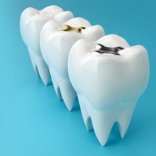 Why Composite Fillings Are Better Than Other Types