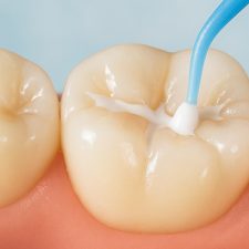 Get Rid of Tooth Cavities With The Aid Of Dental Sealants
