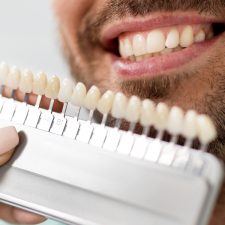 Precautionary Steps After Veneers Treatment
