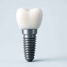 Can I Replace My Missing Teeth with Dental Implants In Clearwater, FL?