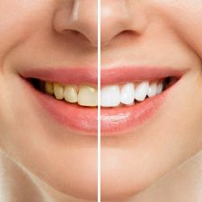 5 Reasons Why You Should Whiten Your Teeth