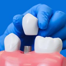Why Dental Arts Clearwater is Your Top Choice for Dental Implants in Clearwater, FL