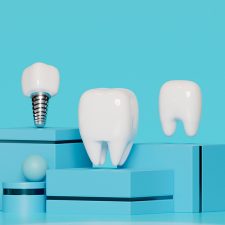 How Long Do Dental Implants Last? Insights from Clearwater Experts
