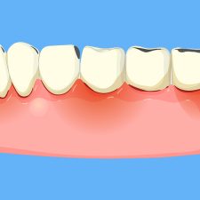 The Cost of Ignoring Periodontal Treatment in Clearwater: What’s at Stake